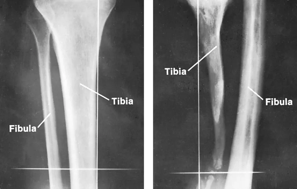 استئومیلیت یا عفونت استخوان. تصویر ساق پای عفونت کرده