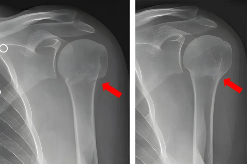 شکستگی گردن استخوان بازو انواع و تشخیص