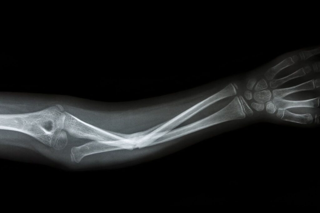 شکستگی تنه استخوان بازو