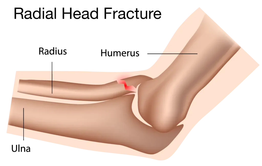 شکستگی سر استخوان رادیوس در ناحیه آرنج