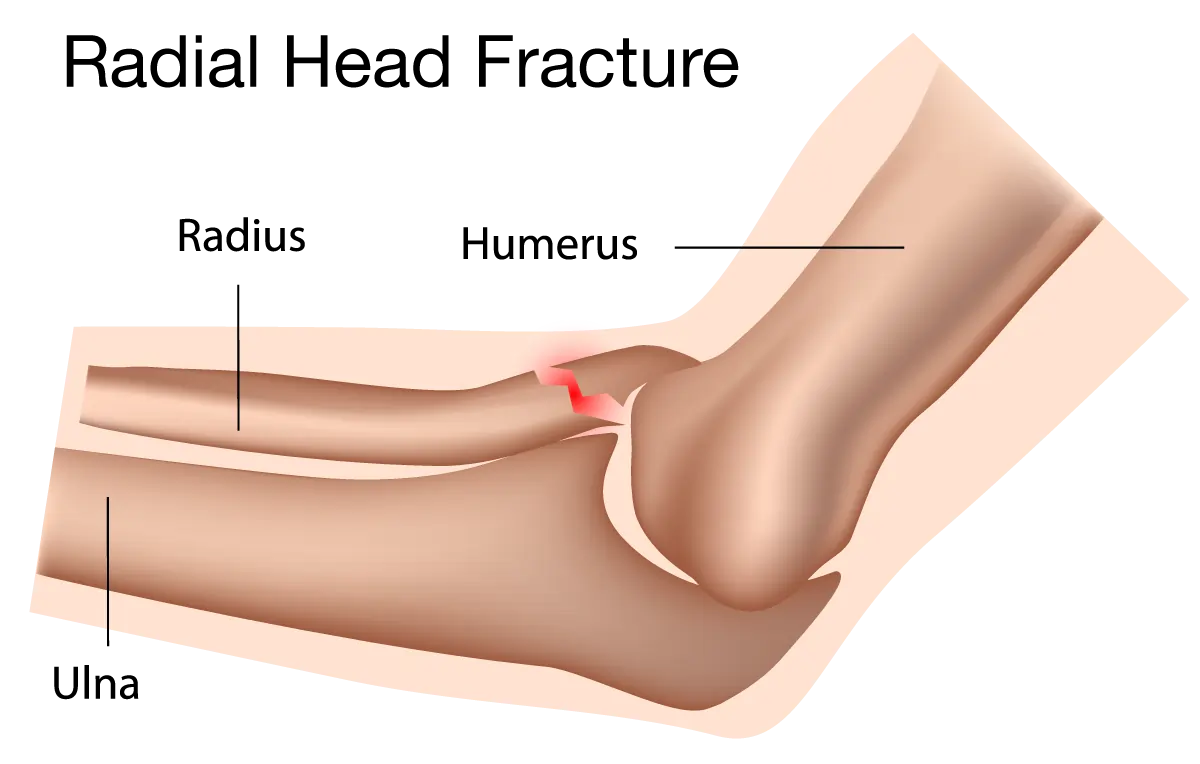 شکستگی سر استخوان رادیوس در ناحیه آرنج