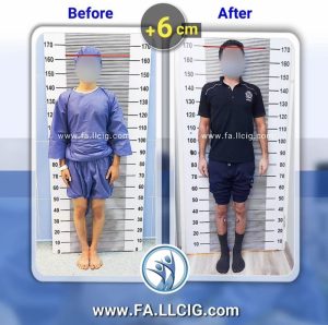 Befor After Limb lengthening surgery 1 1