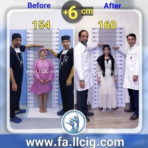 Befor After Limb lengthening surgery 1