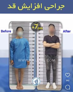 تصویر قبل و بعد از عمل جراحی افزایش قد