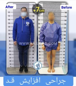 Befor After Limb lengthening surgery 4