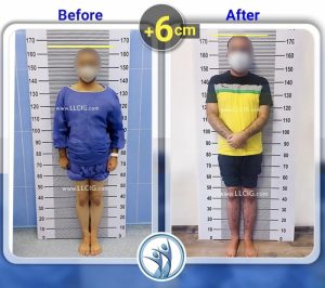 Befor After Limb lengthening surgery 6
