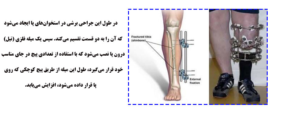 جراحی افزایش قد در اصفهان چگونه انجام می‌شود؟