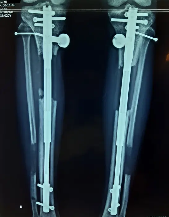 پیگیری بعد از تکمیل کشش – پر شدن استخوان جدید و هم‌محوری ساق‌ها