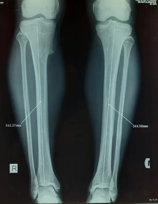 قبل از جراحی – طول اولیه تیبیا حدود ۳۴۳ میلی‌متر