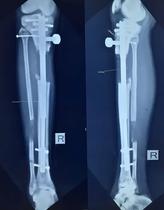 پایان فاز افزایش طول – حدود ۶٫۸ سانتی‌متر افزایش قد ساق