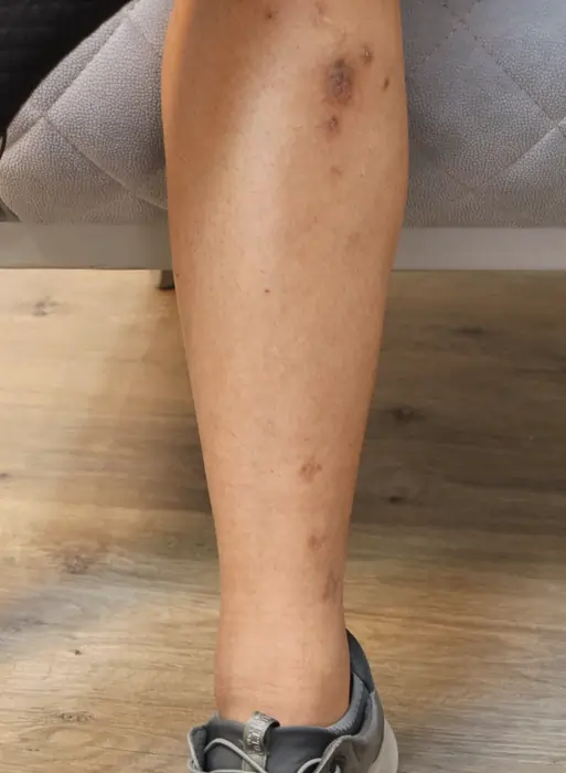 نمای نزدیک از جای بخیه‌ها روی ساق چند ماه بعد از جراحی افزایش قد به روش MTN