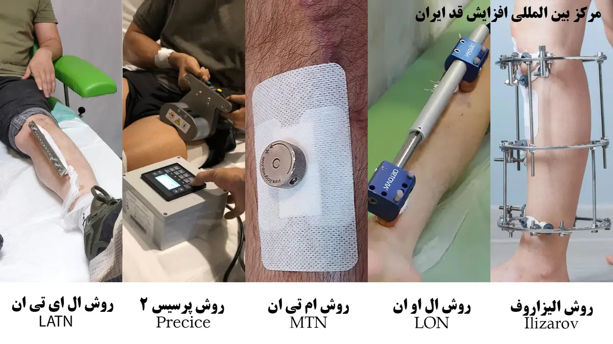 روش-های-جراحی-افزایش-قد2 روش های جراحی افزایش قد2