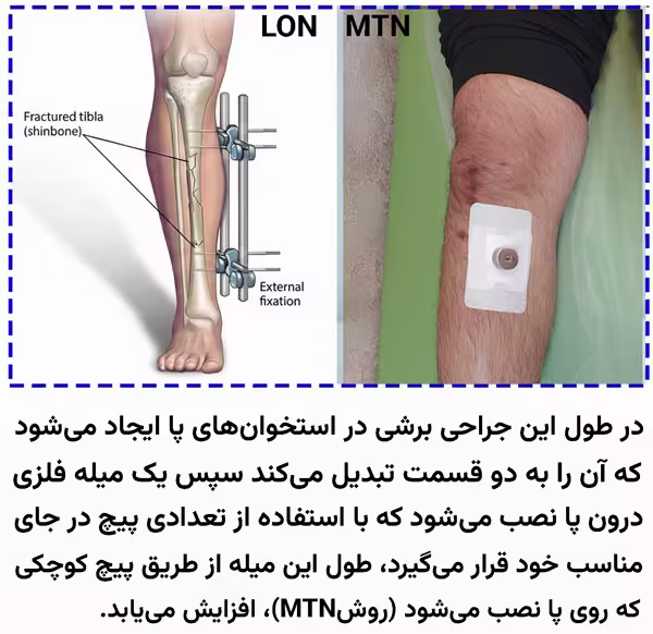 افزایش-قد-عمل-جراحی افزایش قد عمل جراحی