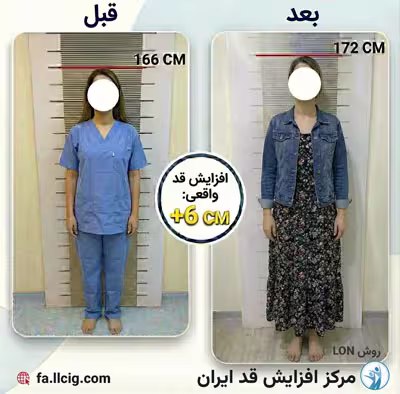 قبل و بعد جراحی افزایش قد - کیس 2