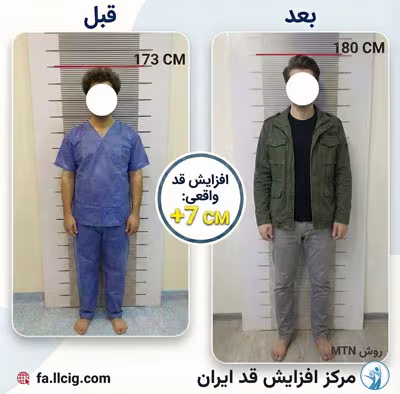 قبل و بعد جراحی افزایش قد - کیس 3