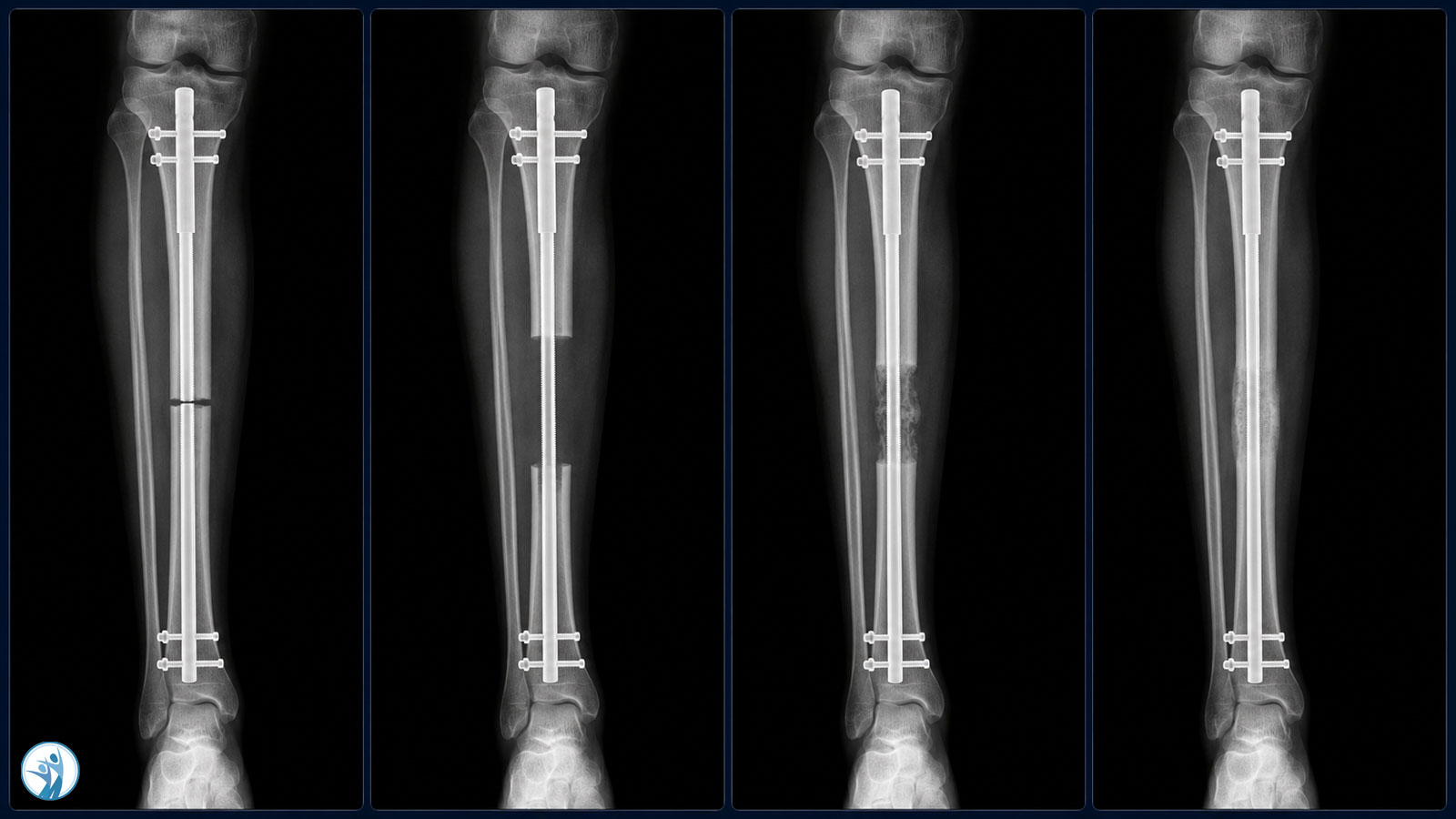 02 regenerate bone stages